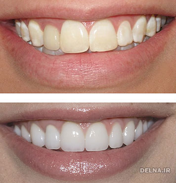 سفید کردن دندان, روش سفید کردن دندان, راههای سفید کردن دندان, آموزش سفیدی دندان, سفیدی دندان, روش خانگی سفیدی دندان