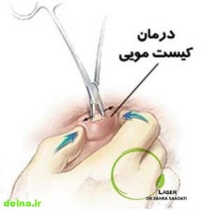 کیست مویی,کیست مویی در زنان,کیست مویی پایین کمر,لیزر کیست مویی,درمان کیست مویی,بهترین دکتر کیست مویی,سینوس پیلونیدال,جراحی کیست مویی, هزینه درمان کیست مویی,دکتر خانم کیست مویی,بهترین دکتر خانم کیست مویی,درمان قطعی کیست مویی,تشخیص کیست مویی,عمل جراحی کیست مویی