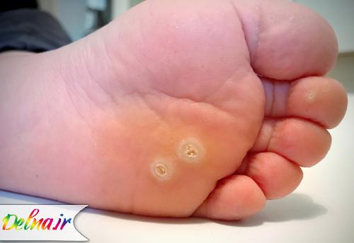 روش های خانگی از بین بردن میخچه